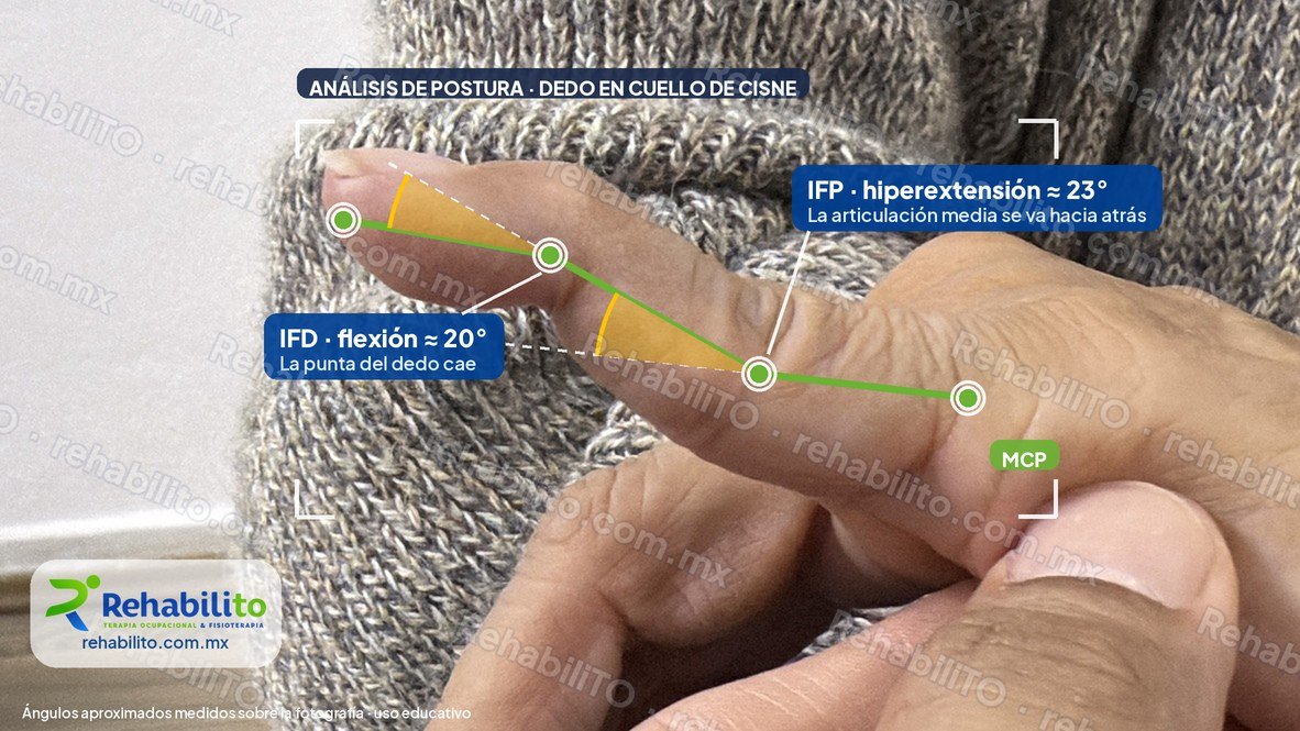 Análisis de postura de un dedo en cuello de cisne con marcadores articulares: hiperextensión de la articulación media y flexión de la punta, RehabiliTO