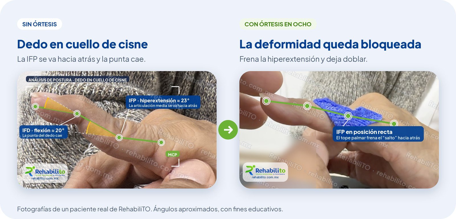 Comparación de un dedo en cuello de cisne sin órtesis, con la articulación media en hiperextensión, y con órtesis en ocho que mantiene el dedo recto, RehabiliTO