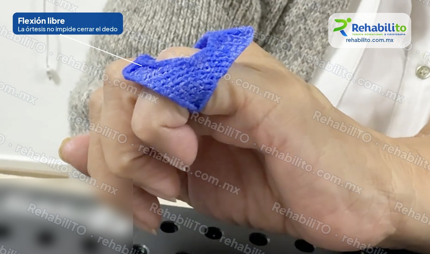 Dedo en flexión con órtesis en ocho a la medida: la órtesis permite doblar el dedo libremente