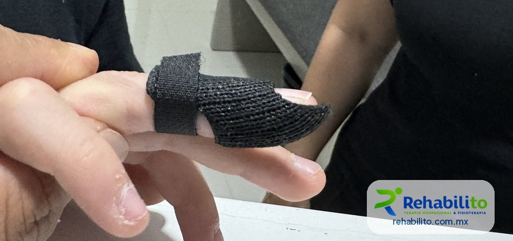 Órtesis a la medida para dedo en martillo que inmoviliza solo la articulación de la punta del dedo, RehabiliTO