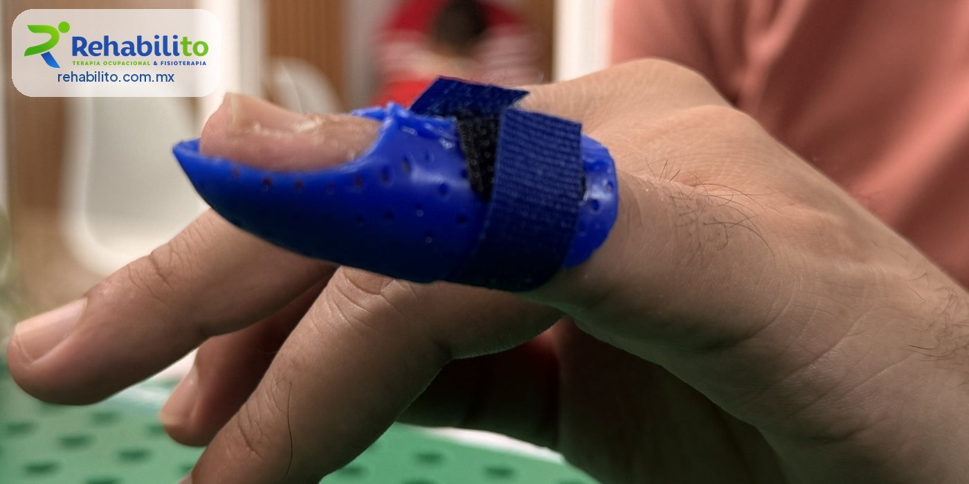 Órtesis en termoplástico azul hecha a la medida para dedo en martillo, RehabiliTO