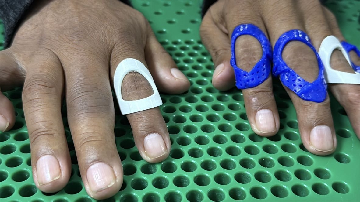 Órtesis tipo anillo impresas en 3D
