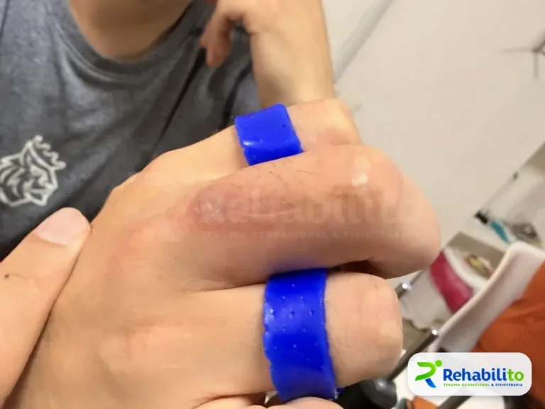 Órtesis tipo anillo. Termoplástico azul en dos dedos. RehabiliTO, CDMX
