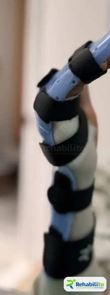 Órtesis de antebrazo y mano. Termoplástico azul con correas. RehabiliTO, CDMX
