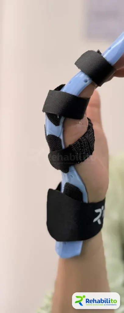 Órtesis de dedo y mano. Termoplástico azul con correas. RehabiliTO, CDMX