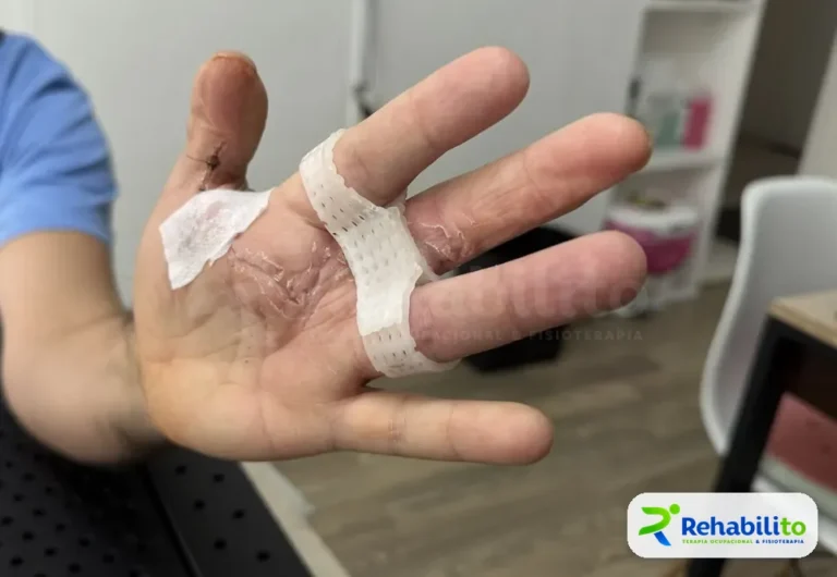 Órtesis para dedos postquirúrgica. Ligera, sobre cicatriz en proceso. RehabiliTO, CDMX