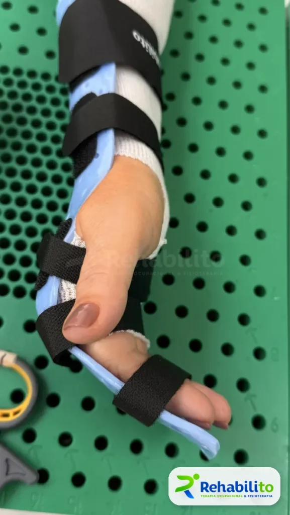 Órtesis de mano y pulgar. Termoplástico azul con correas. RehabiliTO, CDMX