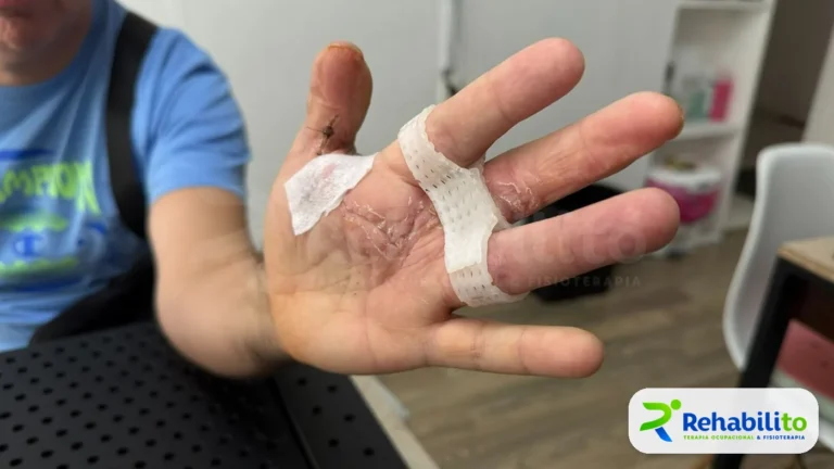 Órtesis de silicona para dedos. Etapa postquirúrgica. RehabiliTO, CDMX