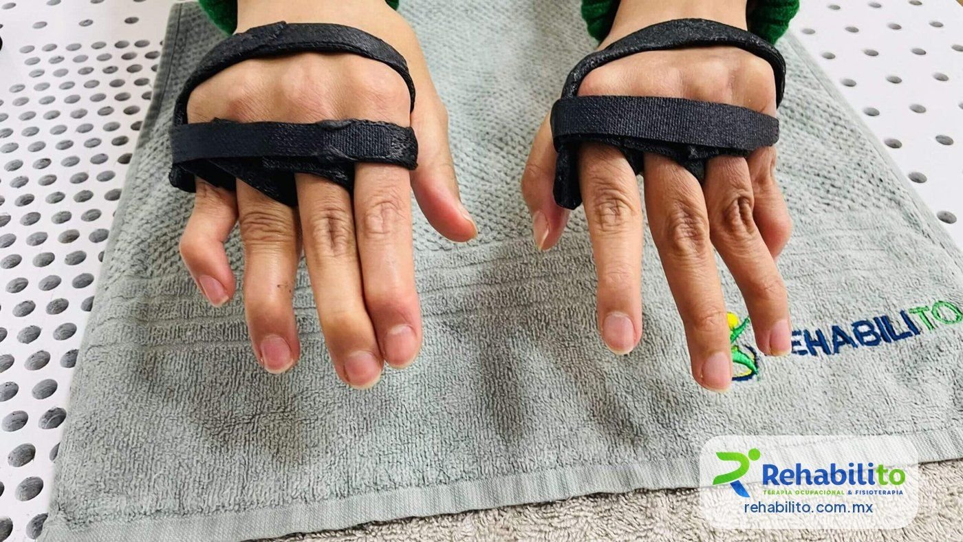 Órtesis de mano hechas a la medida sobre ambas manos